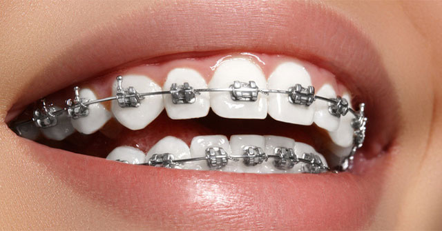 Lịch sử chỉnh nha, niềng răng và những bí mật thú vị ít người biết